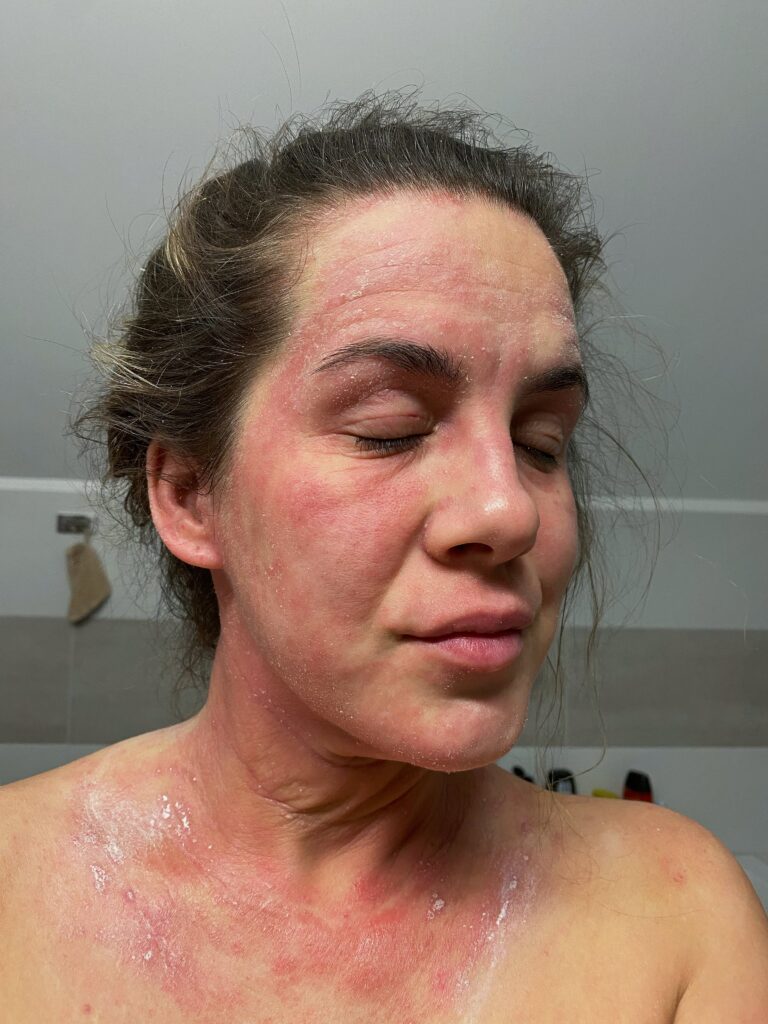 tsw Topical Steroid Withdrawal