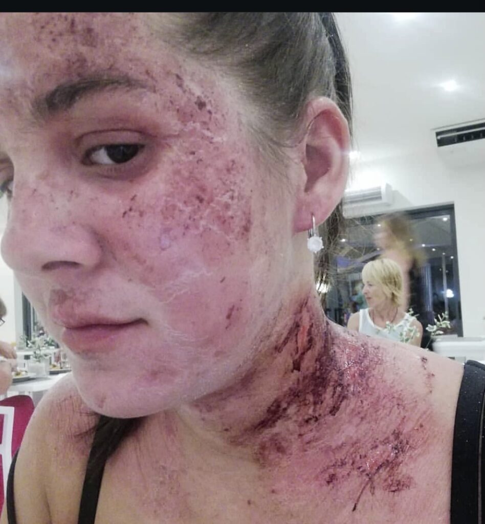 Topical Steroid Withdrawal