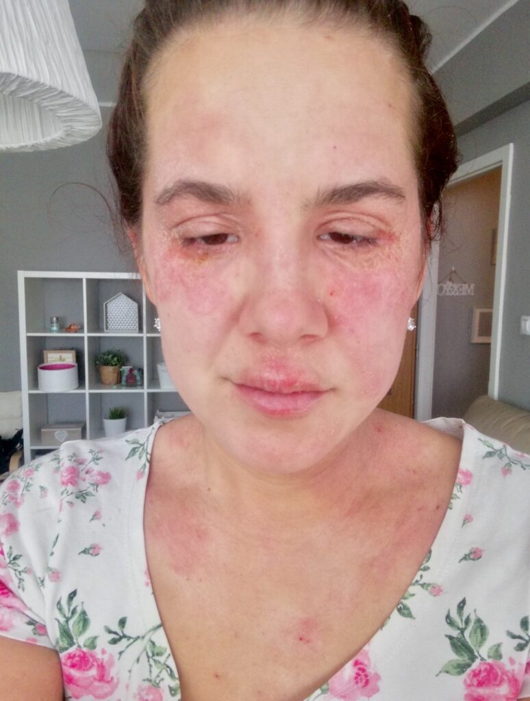 Topical Steroid Withdrawal
